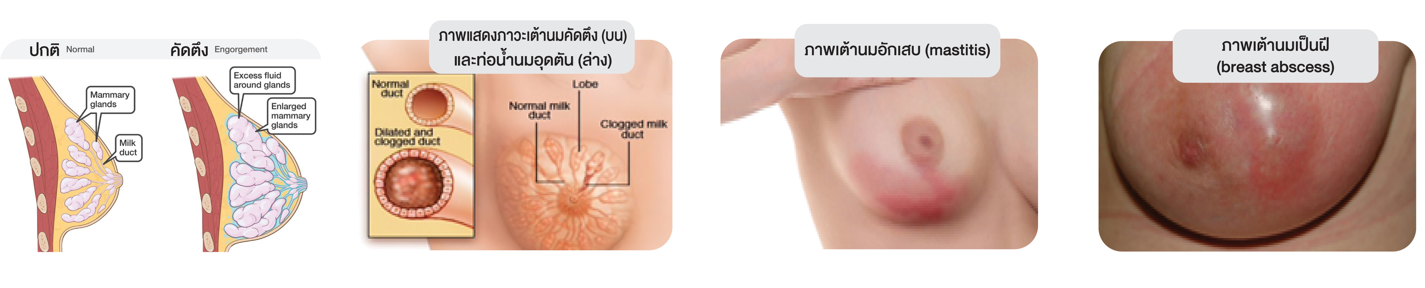 โรงพยาบาลนนทเวช - นวดเปิดท่อน้ำนม และอัลตราซาวด์